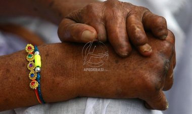 Indonesia, Urutan Ketiga Kasus Kusta Terbanyak di Dunia