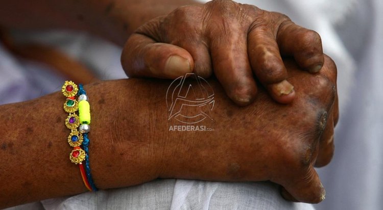 Indonesia, Urutan Ketiga Kasus Kusta Terbanyak di Dunia