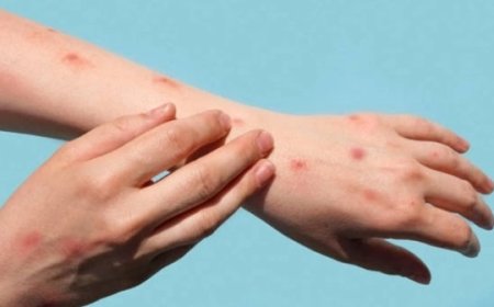 Risiko Kematian Cacar Monyet di Indonesia: Penjelasan dari Pakar Mikrobiologi