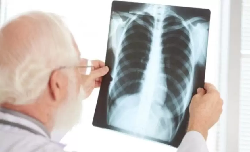 Penyakit Paru Obstruktif Kronis (PPOK): Ancaman Global yang Memerlukan Perhatian Serius