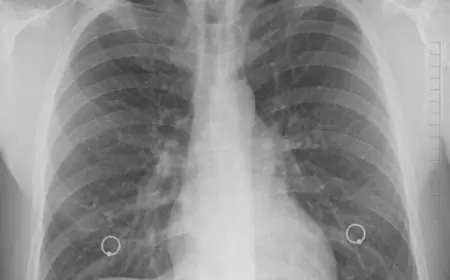 Wabah Pneumonia Mycoplasma Muncul di China, Belanda, dan Indonesia Menimbulkan Kekhawatiran Pandemi Baru