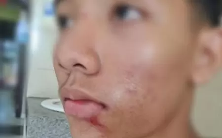 Siswa SMP Dianiaya Temannya hingga Pingsan, Orang Tua Lapor ke Polisi