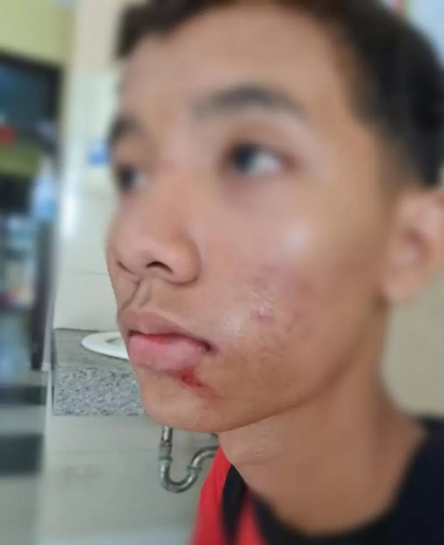 Siswa SMP Dianiaya Temannya hingga Pingsan, Orang Tua Lapor ke Polisi